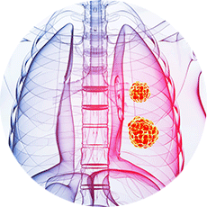 lung-cancer-tumor-230x230-01